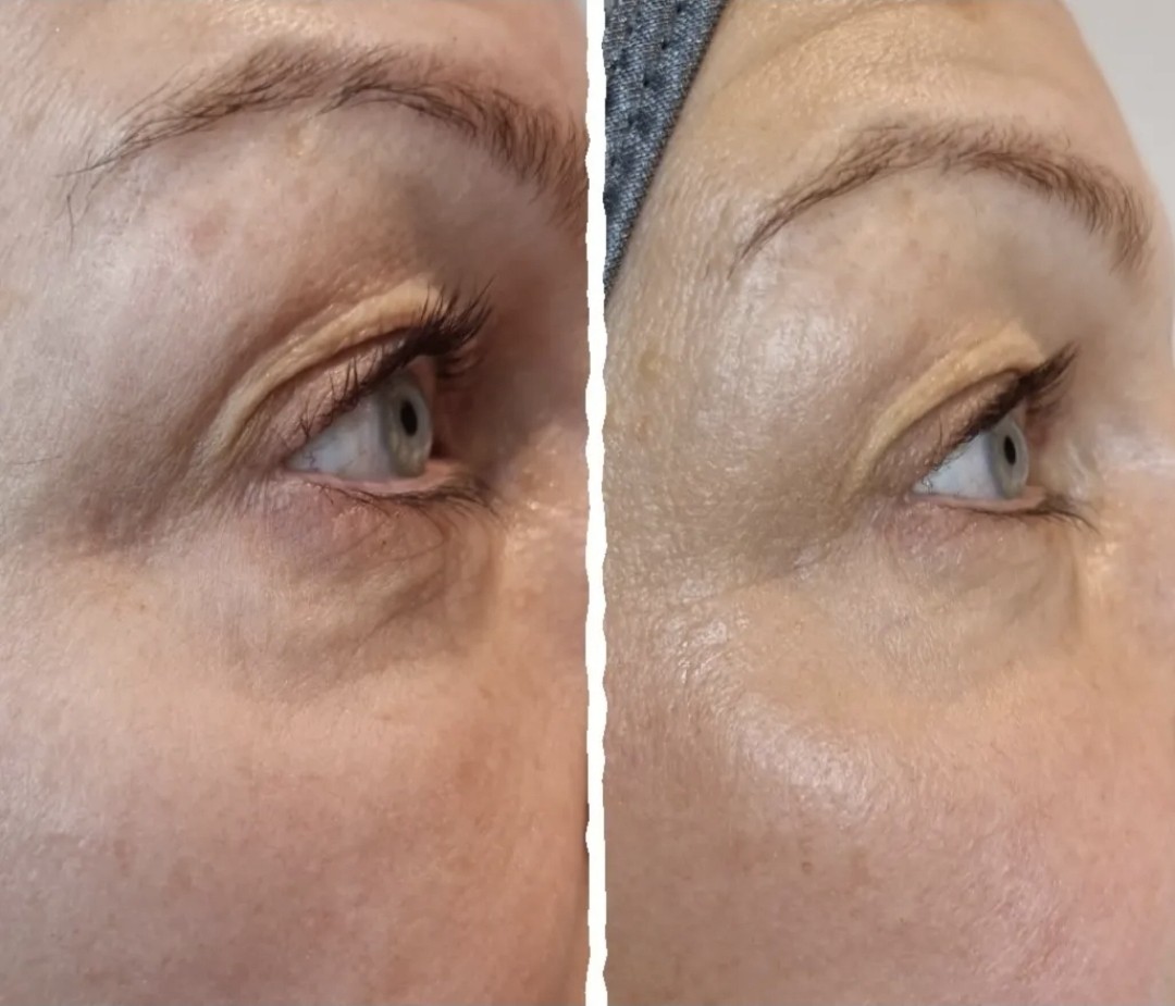 Before and after comparison of skin around the eye, shown side by side
